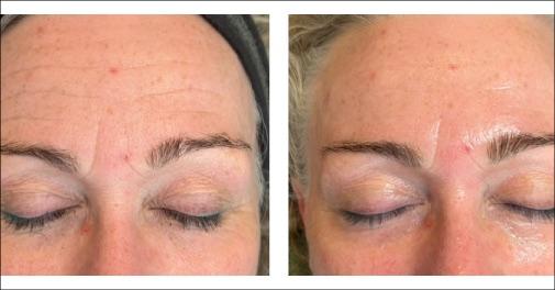 Japansk Bio Micro Needling Peeling med markant hudforbedring