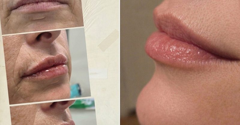Dermal Filler for Lips and More at AMD Esthetica
