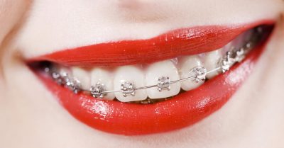 Transform Your Smile with Braces at AllsmileNetwork