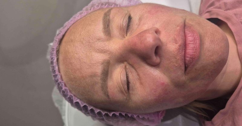 Revitalize Your Skin with Micro-Needling at AURA Aesthetics
