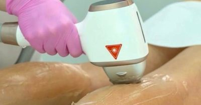 Laser Hair Removal Experience at HL Lasers