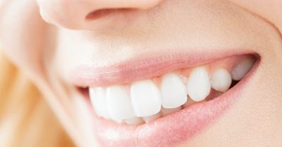 Dental Check-Up with Teeth Whitening at Allure Dental Care & Aesthetics