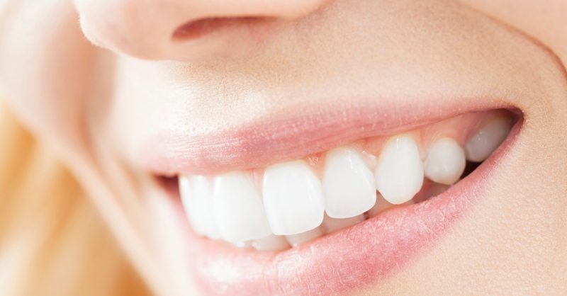 Dental Check-Up with Teeth Whitening at Allure Dental Care & Aesthetics