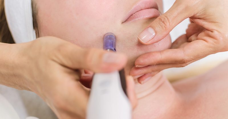 Revitalize Your Skin with Microneedling at Essense Aesthetic Beauty Clinic