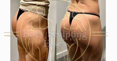 Transform Your Body with Sculpting & Private Sauna at Body Sculpting Essex