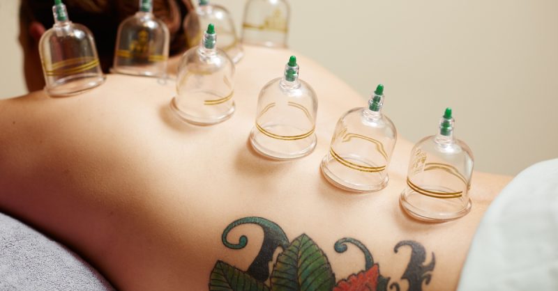 Revitalize with Cupping at Alshifa Health Center