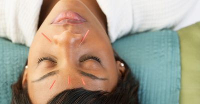 Cupping and Acupuncture Treatment at DrHealth