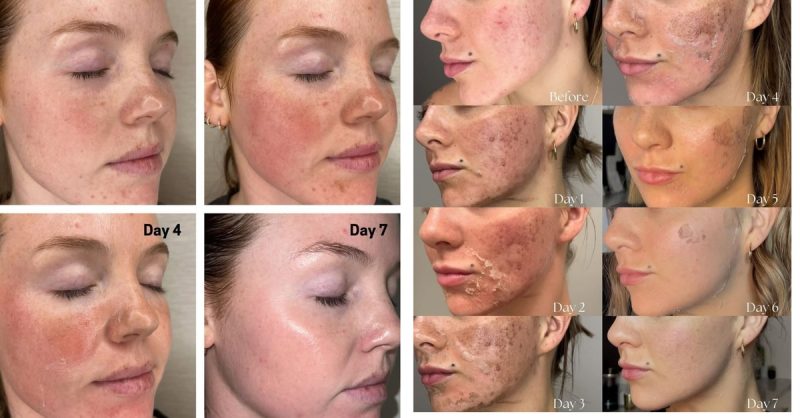 Revitalize Your Skin with a Chemical Peel at bc clinic