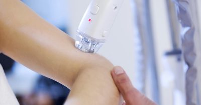 Experience Three Skin Tag Removals at Lindo Aesthetics