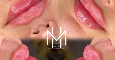 Dermal Filler Injection at Skin masters london