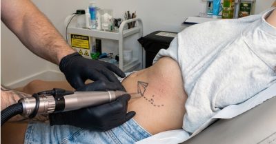 Expert Tattoo Removal at London Laser tattoo removal