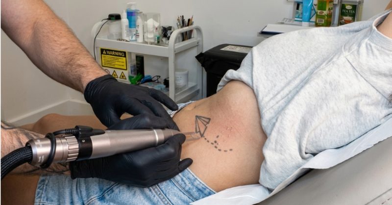 Expert Tattoo Removal at London Laser tattoo removal