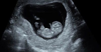 Early Pregnancy or 4D Fetal Health Scan at Window To The Womb, Harlow