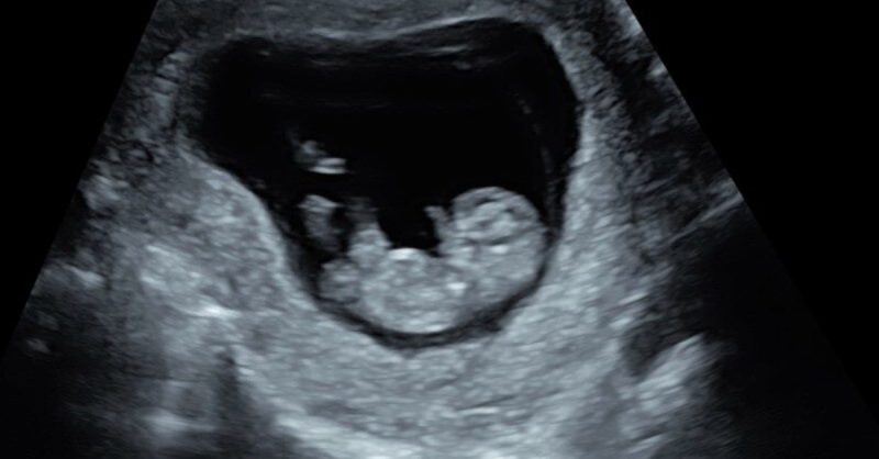 Early Pregnancy or 4D Fetal Health Scan at Window To The Womb, Harlow