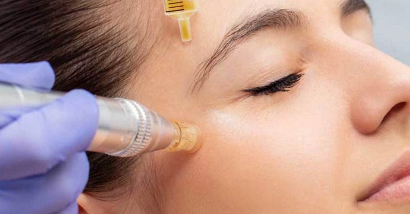 PRP Skin Treatment for Face and Neck at Brows And Beauty Masters