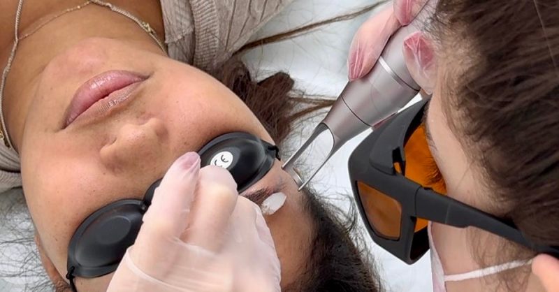 Eyebrow Tattoo Removal at HL Lasers