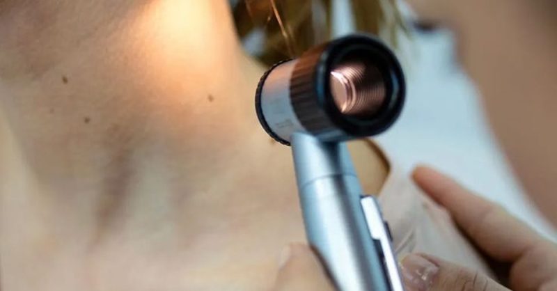 Electrolysis Skin Lesion Removal at Soft Soles Beauty And Aesthetics