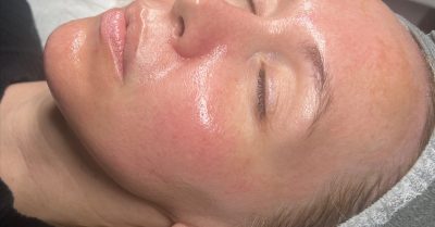 HydraFacial at RefreshSkinTherapy for a Radiant Glow