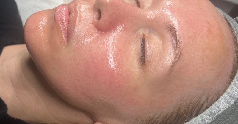 HydraFacial at RefreshSkinTherapy for a Radiant Glow