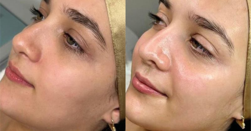 Rejuvenating Chemical Peel at Aesthetics by Rae for Radiant Skin