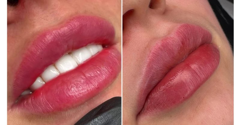 Classic or Russian Dermal Fillers at RP Permanent Makeup & Laser Removal