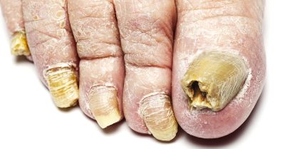Professional Fungal Toenail Consultation at Raymond Nash Clinic
