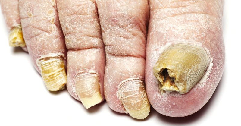 Professional Fungal Toenail Consultation at Raymond Nash Clinic