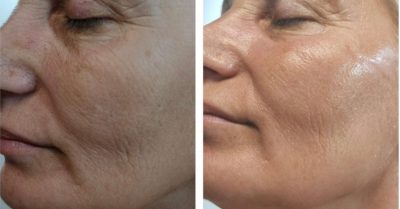 Revitalize Your Skin with HydraFacial at Fida Aesthetic - Aesthetic Boutique