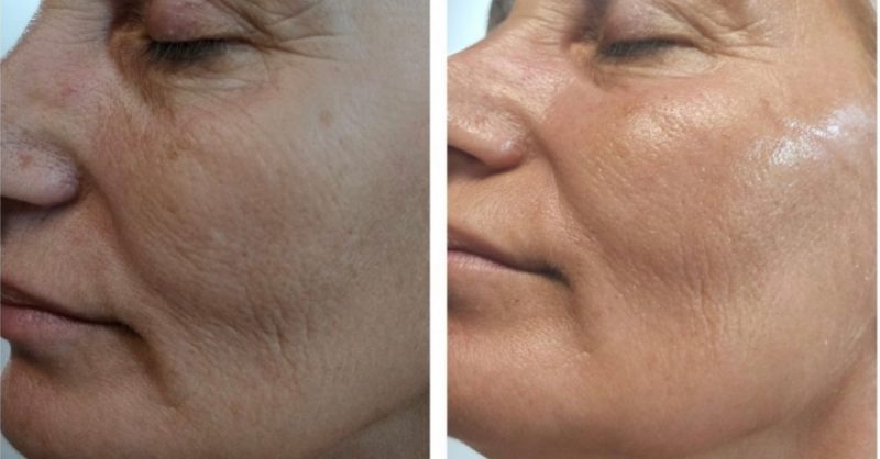 Revitalize Your Skin with HydraFacial at Fida Aesthetic - Aesthetic Boutique