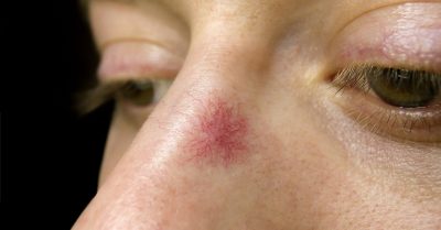 Laser Thread Vein Removal at Yorkshire Laser and Beauty Clinic