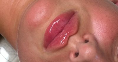 Dermal Filler Treatments at The Buckingham clinic