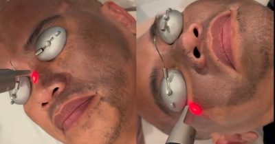 Pico Laser Carbon Peel at bc clinic with Complimentary Facial Cleaning