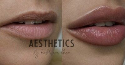 Perfect Lip Filler Options at Aesthetics by Rukhsana Khan