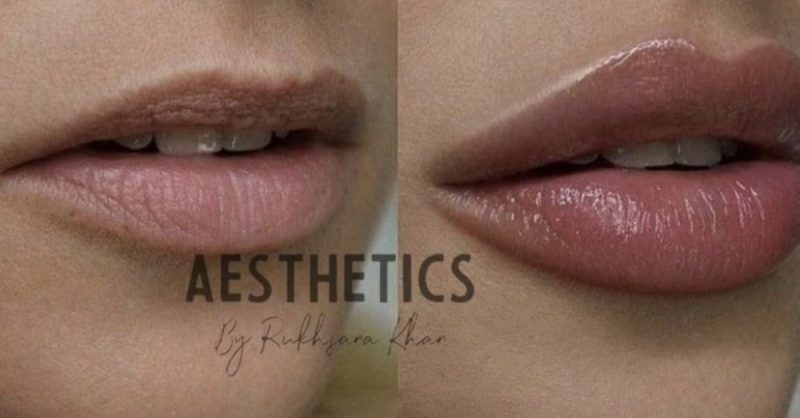 Perfect Lip Filler Options at Aesthetics by Rukhsana Khan