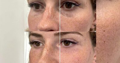 Two Profhilo® Sessions for Skin Hydration at aesthetic zone