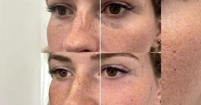 Two Profhilo® Sessions for Skin Hydration at aesthetic zone