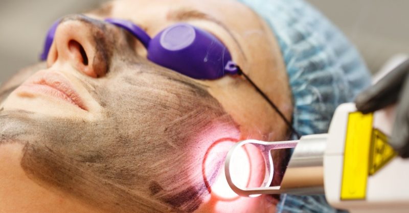 Radiant Skin with Carbon Laser Peel Facial at Agatha K Micropigmentation