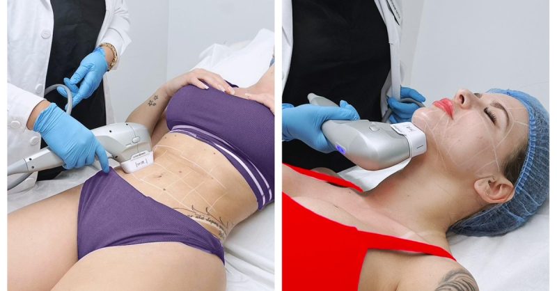 HIFU Face & Body Sessions at Seth Aesthetics Clinic