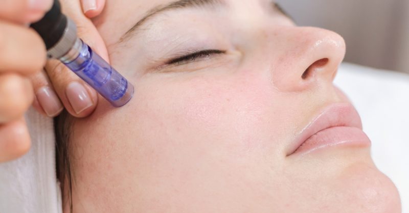 Luxury Microneedling and aCleanse Facial at additions aesthetics