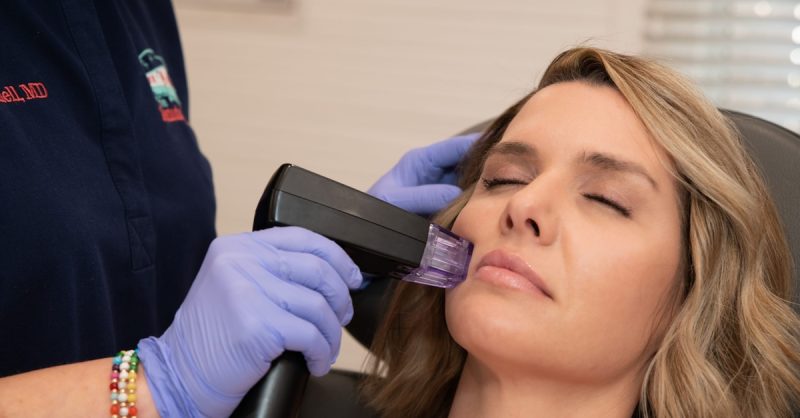 Morpheus8 Microneedling for Face or Neck at N20 Beauty & Laser Parlour