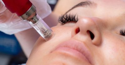 Revitalize Your Skin with Microneedling at Regains Beauty & Aesthetics