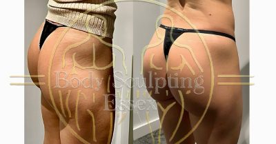 Electromagnetic Sculpting with Private Sauna at Body Sculpting Essex