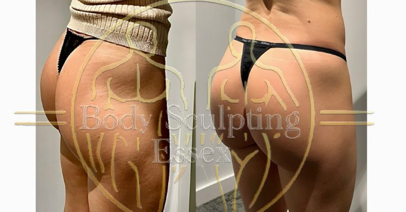 Electromagnetic Sculpting with Private Sauna at Body Sculpting Essex