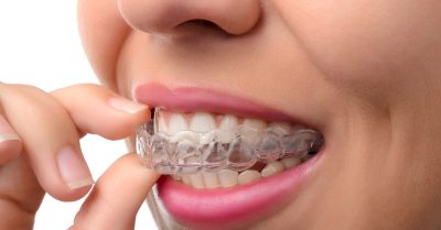 Invisible Aligners, Retainers, or Mouthguard at A La Dental Clinic