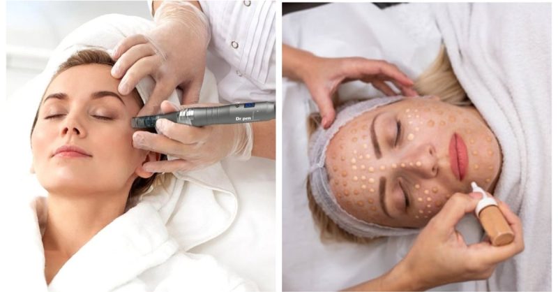 Microneedling Sessions at Benson Beauty Aesthetics