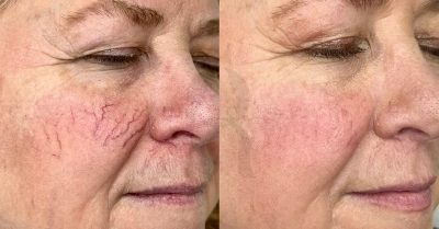 Advanced Thread Veins & Spider Naevi Removal at aesthetic zone