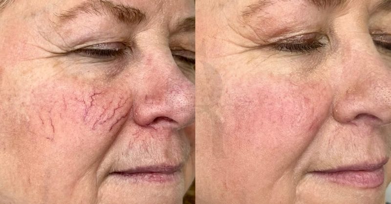 Advanced Thread Veins & Spider Naevi Removal at aesthetic zone