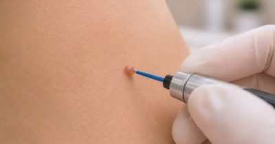 Cryotherapy Skin Tag and Verruca Removal at AandS Aesthetic and Beauty