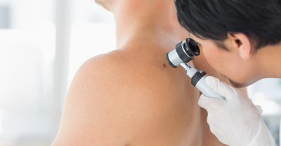 Mole and Skin Tag Removal at Neo Derm