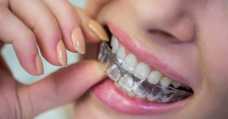 Clear Braces for One Arch at Unique Dental and Facial Clinic